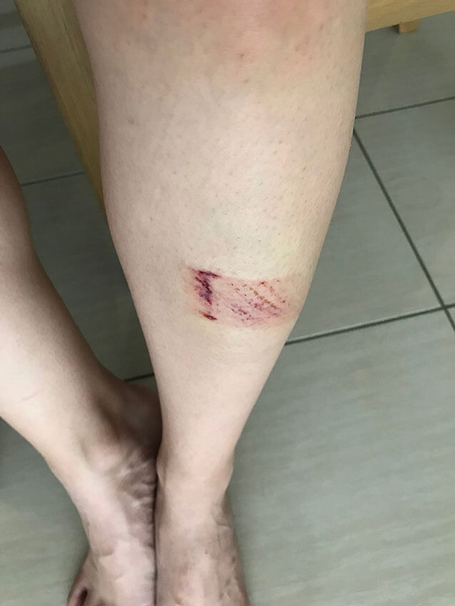 A leg with a heavy bruise on the shin, about the size of a small pack of gum. It’s deep red in some areas